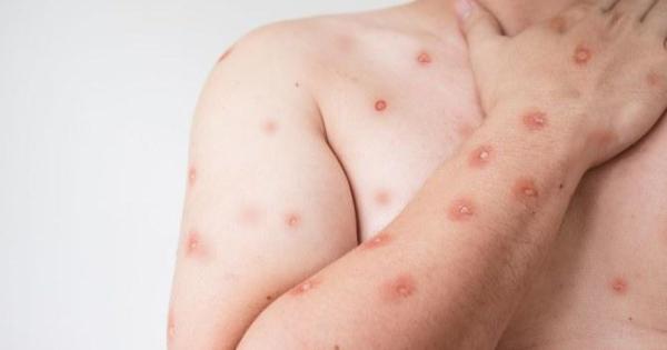 SES alerta para monitoramento de casos de Mpox em MT após avanço de variante em Rondônia