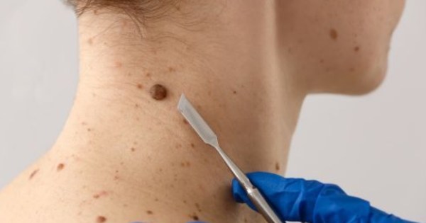 Prefeitura de Cáceres amplia atendimento dermatológico e reforça cuidado com a saúde da pele